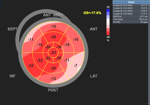 Image 7 : échocardiographie Strain longitudinal global (SLG) avec image en bull eye