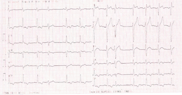 Électrocardiogramme