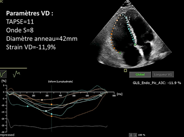 ETT/Strain VD