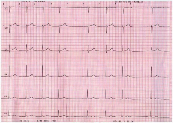 une-CMH-toujours-symptomatique-figure10