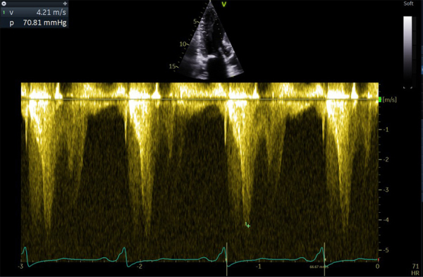 Gradient maximal intra VG en doppler continu