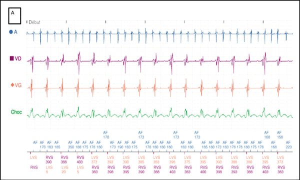 amylose-et-arythmie-figure2