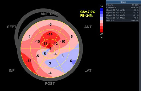 SLG altérée -15% avec un gradient base-apex >1 et septum basal-apical>2,1