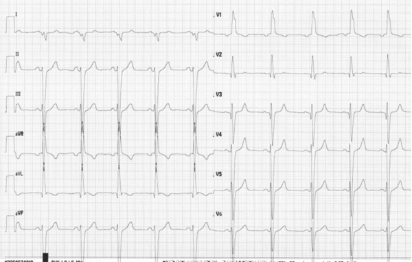Electrocardiogramme