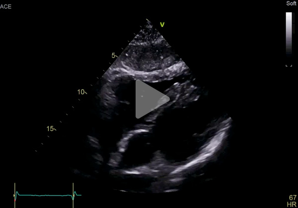 Vidéo 4 - cas clinique "Une amylose AL précoce"