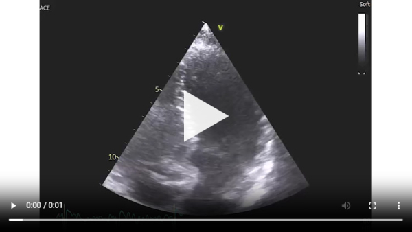 Vidéo 1 : échocardiographie 2D en incidence parasternale grand axe
