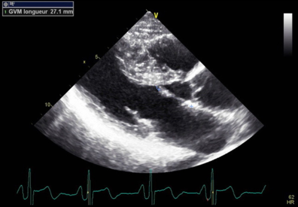 Figure 2 : Mécanisme de la dyspnée d’effort : obstruction latente sur élongation de la grande valve mitrale (supérieur ou égale à 27 mm) associée à la CMH sarcomérique