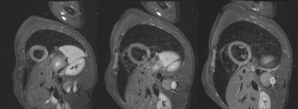 imagerie-cardiaque-cas-clinique-en-direct-de-Lariboisiere-sequence-t2-stir