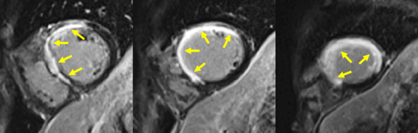 Figure 3 : Séquence de rehaussement tardif - Coupes petit-axe