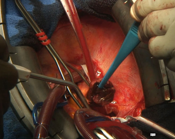 Figure 10 : Thrombus auricule