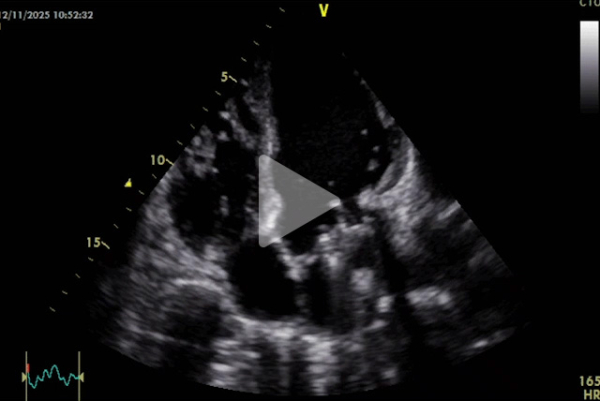 Complication-rare-d-un-remplacement-valvulaire-mitrale-video1-img.jpg