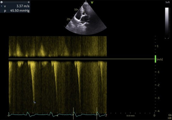 Flux doppler continu trans-aortique