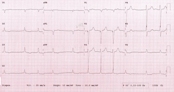 Fibrillation atriale et pseudo-onde Q de nécrose