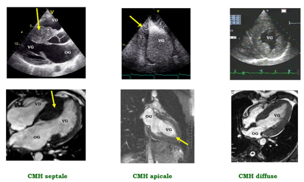 Figure 1 : Différentes formes et topographies des cardiomyopathies hypertrophiques En haut, aspect échocardiographique, en bas : aspect IRM