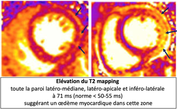 imagerie-cardiaque-cas-clinique-en-direct-de-Lariboisiere-sequence-sequence-t2-mapping