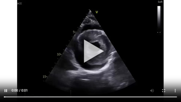 Vidéo 2. Coupe parasternale petit axe