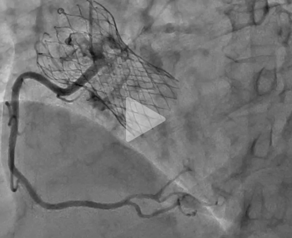 Deux-ans-apr&egrave;s-un-TAVI-le-silence-du-sinus-coronaire-gauche-video3-img.jpg