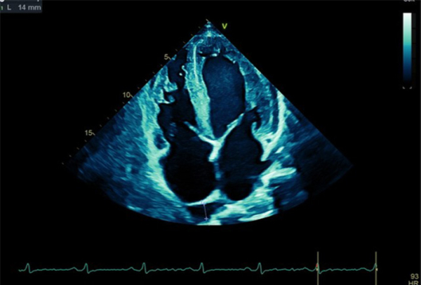 Examens du patient : Echocardiographie bilan de dyspnée , en RS