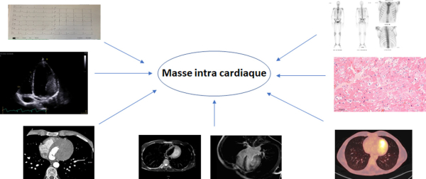 Le syndrome du Caméléon - Masse intra cardiaque