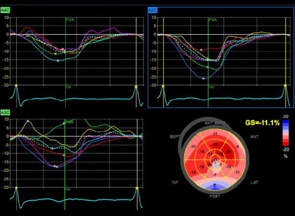 Altération du strain basal dyskinésie apicale