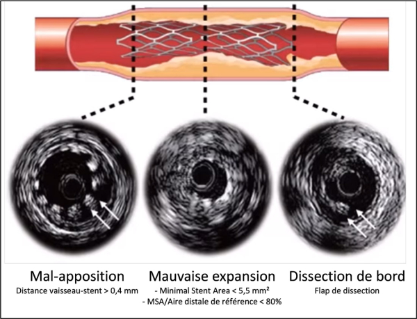 Exemple de mal apposition, mauvaise expansion et dissection de bord post angioplastie par IVUS
