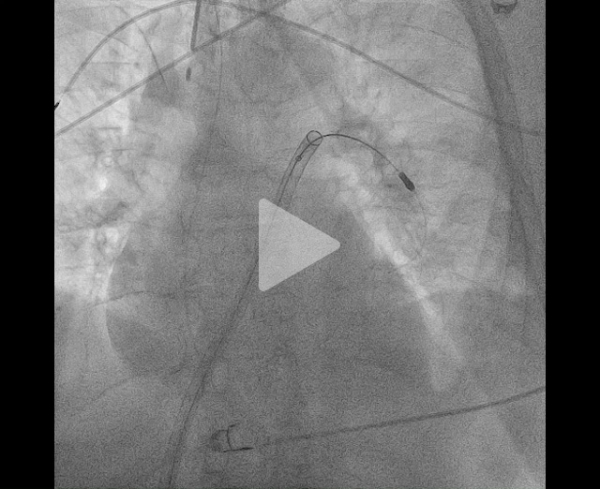 un-infarctus-mais-pas-du-myocarde-vidéo7-img