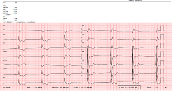 ECG de la consultation en FA lente à 40bpm