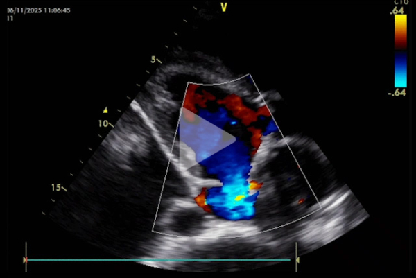 Complication-rare-d-un-remplacement-valvulaire-mitrale-video10-img.jpg