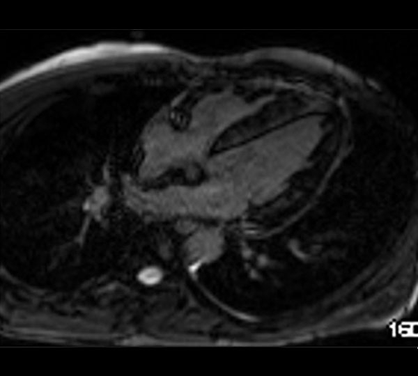 Image 6 du cas clinique "Une amylose AL précoce"