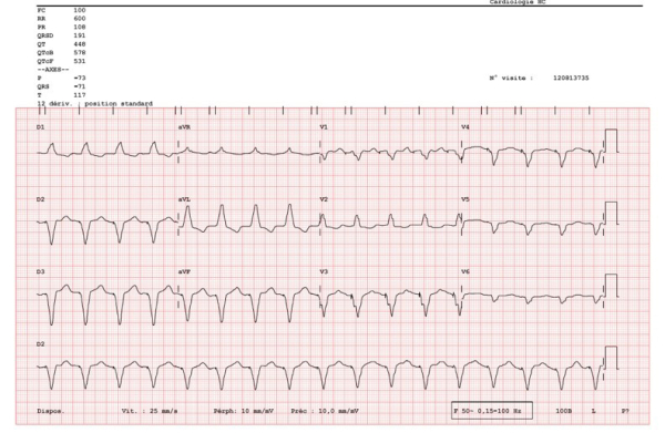 ECG