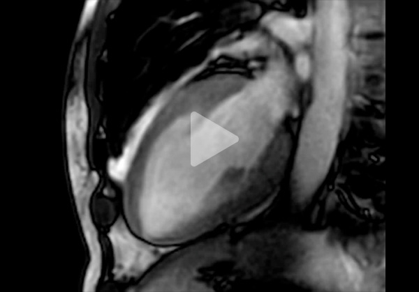 Vidéo 6 du cas clinique "Une amylose pas comme les autres"