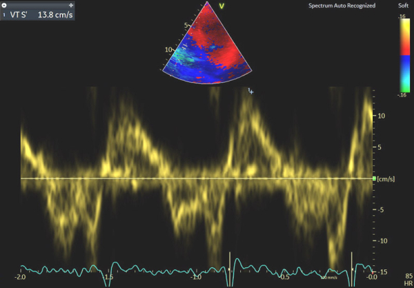 Image 5 : échocardiographie Doppler tissulaire à l’anneau tricuspide