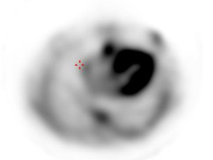 Scintigraphie cardiaque avec traceur osseux