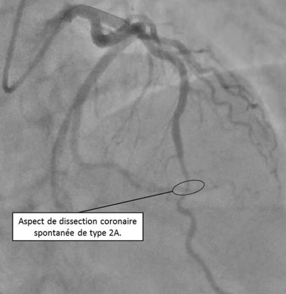 Figure 2 : Coronarographie : Réseau coronaire gauche - incidence apicale (10/40)