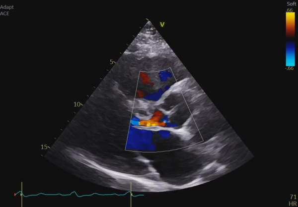 une-CMH-toujours-symptomatique-figure3