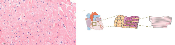Le syndrome du Caméléon - Biopsie myocardique par voie endovasculaire