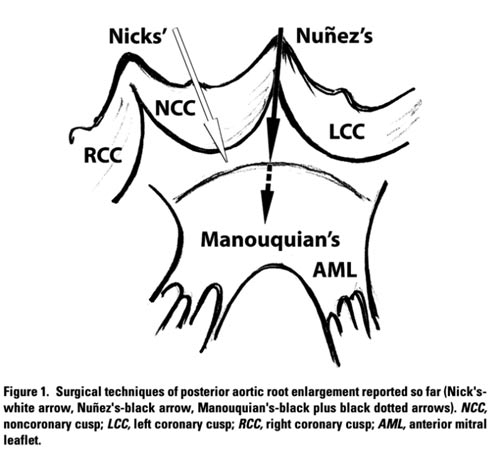 Figure1. Surgical techniques of posterior aortic root enlargement reported so far
