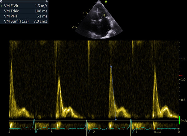 Figure 2 : Profil restrictif onde L