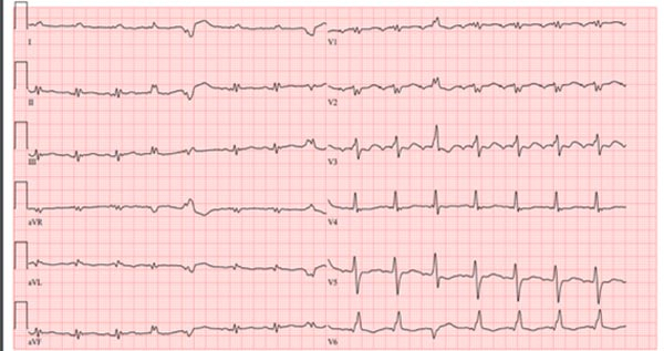 ECG - Microvoltage périphérique non connue