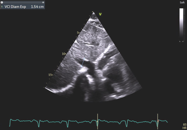 Image 10 : échocardiographie 2D en incidence sous-costale, mesure du diamètre de la veine cave inférieure