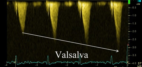 Enregistrement en Doppler continu d’un gradient intra-VG se majorant lors de la manœuvre de Valsalva chez un patient ayant une cardiomyopathie hypertrophique non-obstructive au repos