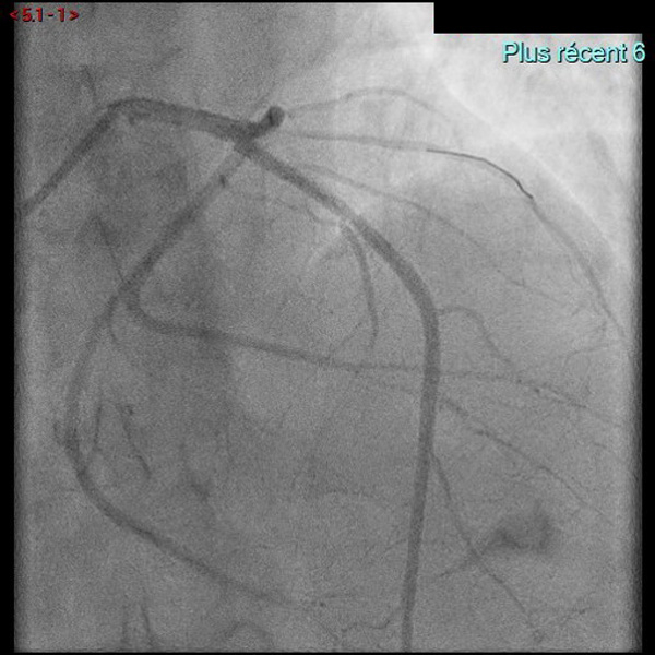 -Occlusion de la 3è septale avec un ballon. - Injection de Sonovue permettant de montrer la surbrillance la zone du septum au niveau du bourrelet septal mais aussi d’un pilier aberrant. - Alcoolisation