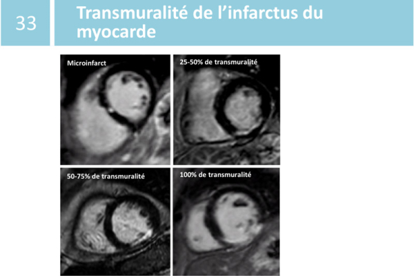 Fiche de synthèse : évaluation de la viabilité myocardique