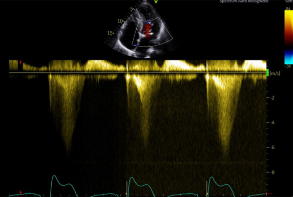 Superposition des 2 flux doppler continu d’obstruction sous aortique et d’IM
