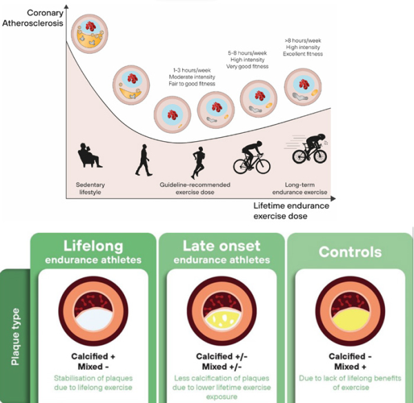 Figure 4 : Evolution de la plaque d’athérosclérose selon l’activité physique 
