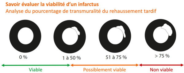 Savoir évaluer la viabilité d'un infarctus - Analyse du pourcentage de transmuralité du rehaussement tardif