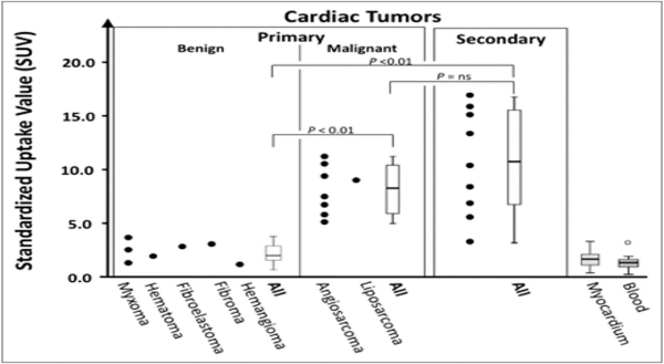 Le syndrome du Caméléon - Tumeurs cardiaques – TEP TDM 18F FDG