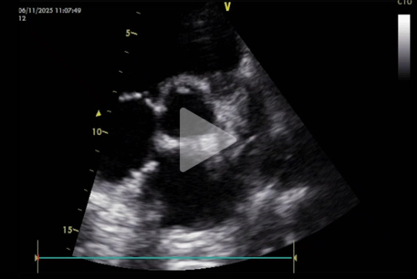 Complication-rare-d-un-remplacement-valvulaire-mitrale-video4-img.jpg