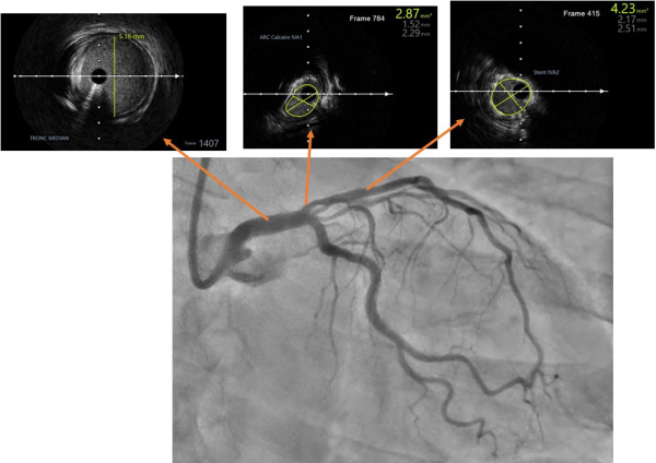 Extraits des acquisitions IVUS pré angioplastie