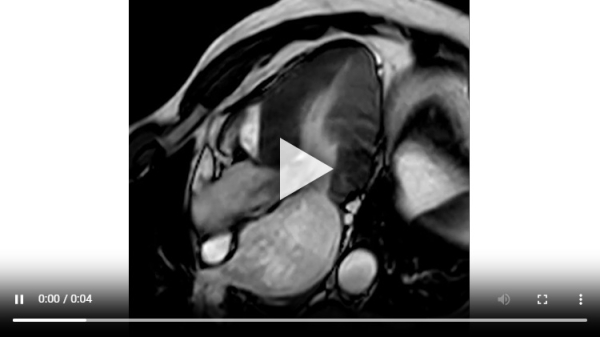 Vidéo 1 : Ciné-IRM montrant un flux d’obstruction sous-aortique en regard d’une zone d’hypertrophie septale.